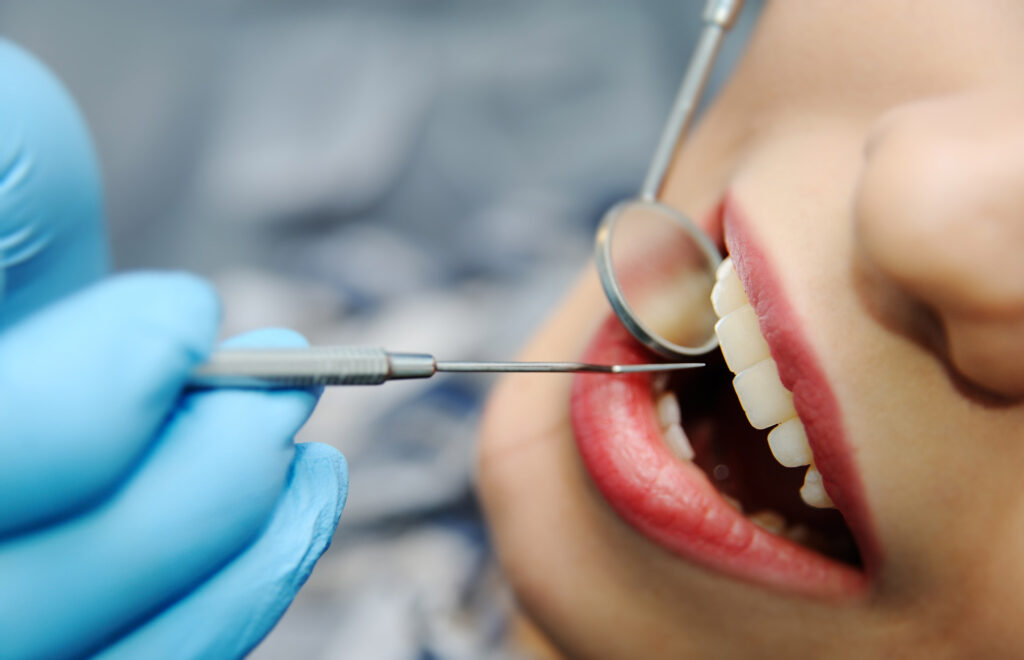 glass ionomer filler 1
