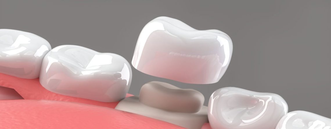 Dental Geçici Kron