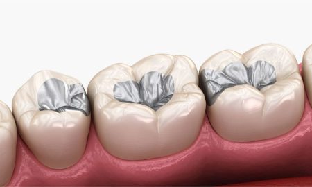 Bulk Fill Kompozit Nedir